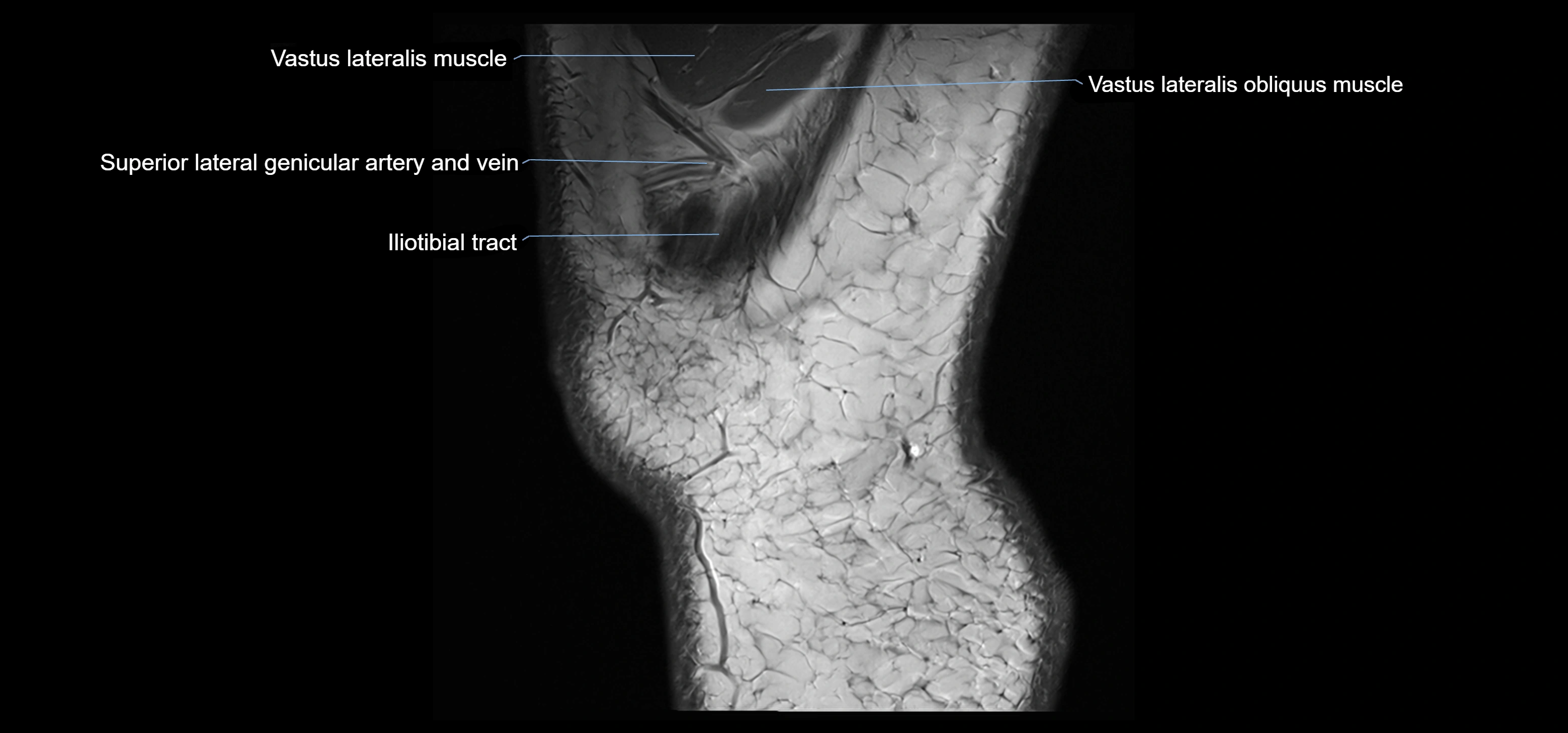 MRI knee sagittal cross sectional anatomy labelled 3T radiology image-00045.webp